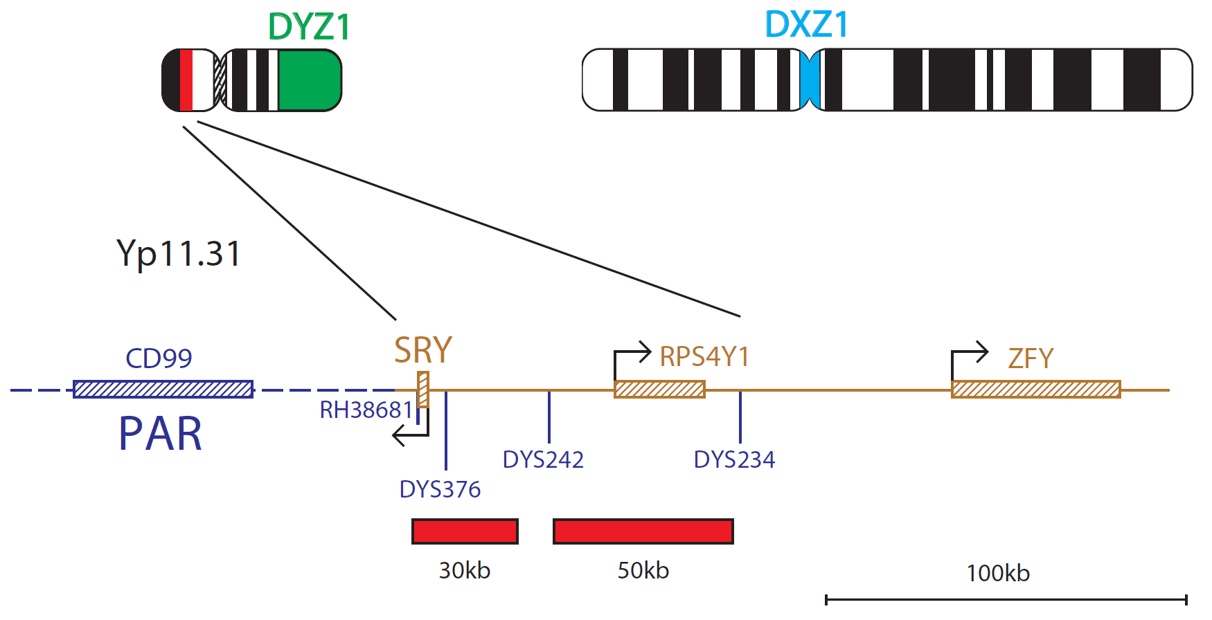 Fluorescence in situ hybridization (FISH) chromosome map showing probes targeting the SRY (sex-determining region Y) gene.