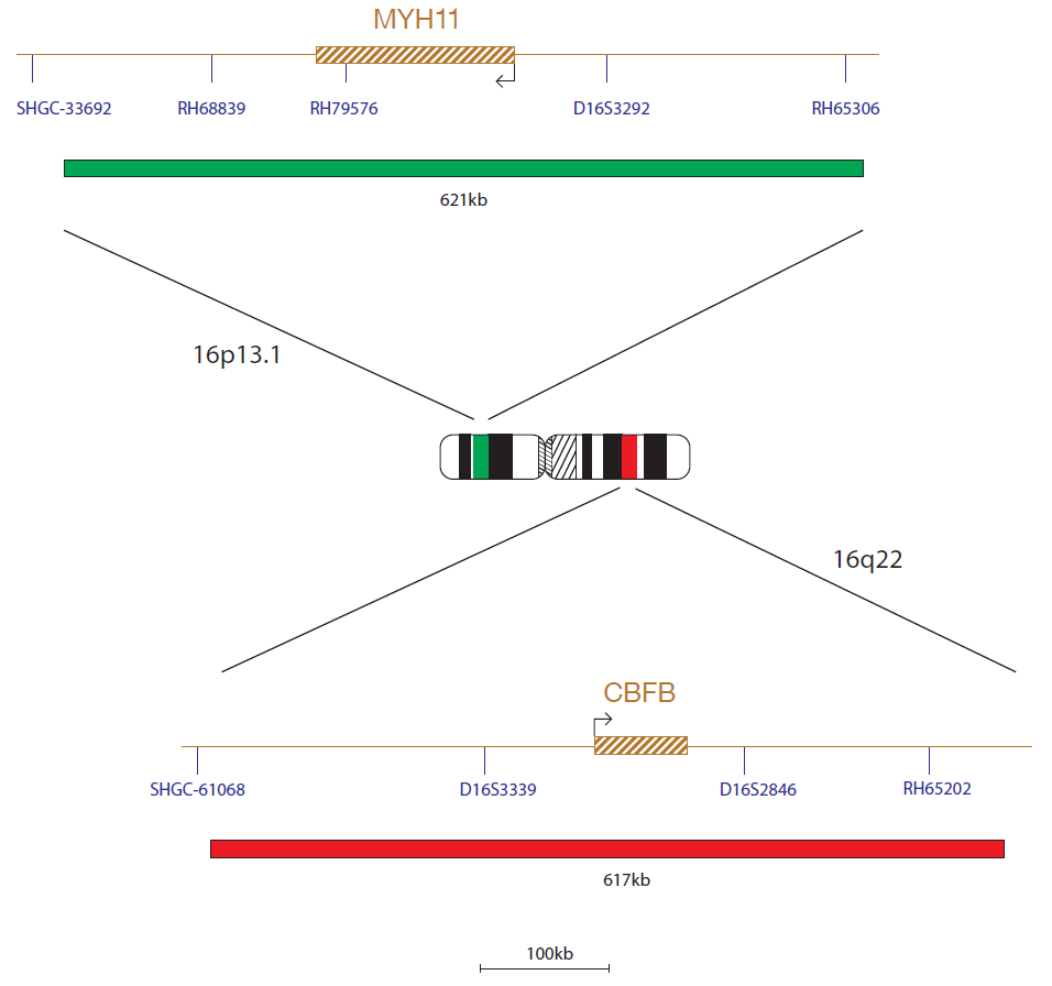 Fluorescence in situ hybridization (FISH) chromosome map showing a probe targeting the CBFβ (CBFB) and MYH11 genes.